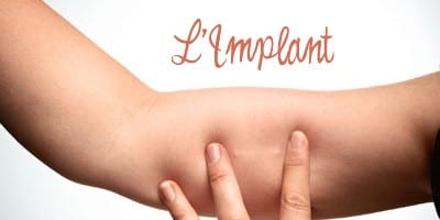 implant contraceptif