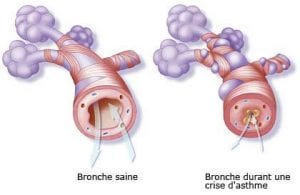 illustration crise d'asthme