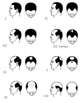 classification alopecie
