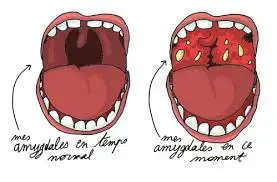 Soigner Rapidement Une Angine Symptomes Traitements Possibles