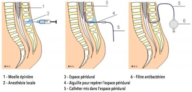 Schéma-Péridurale