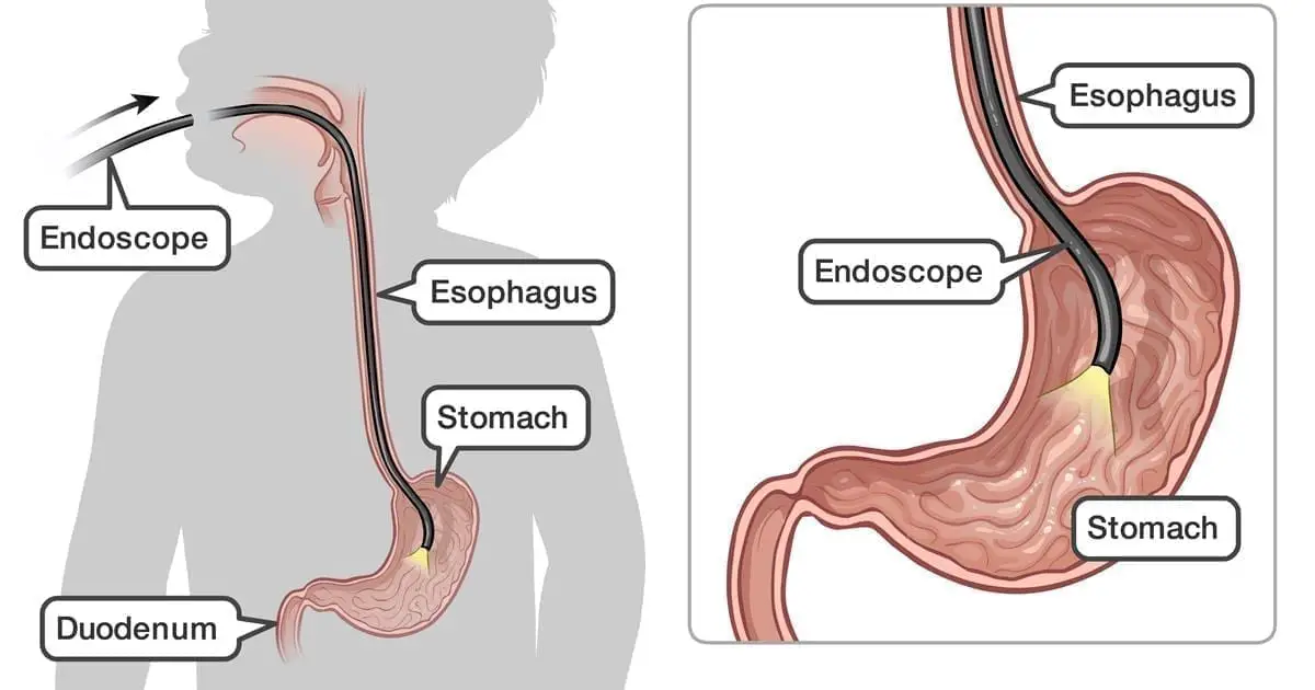 endoscopie haute