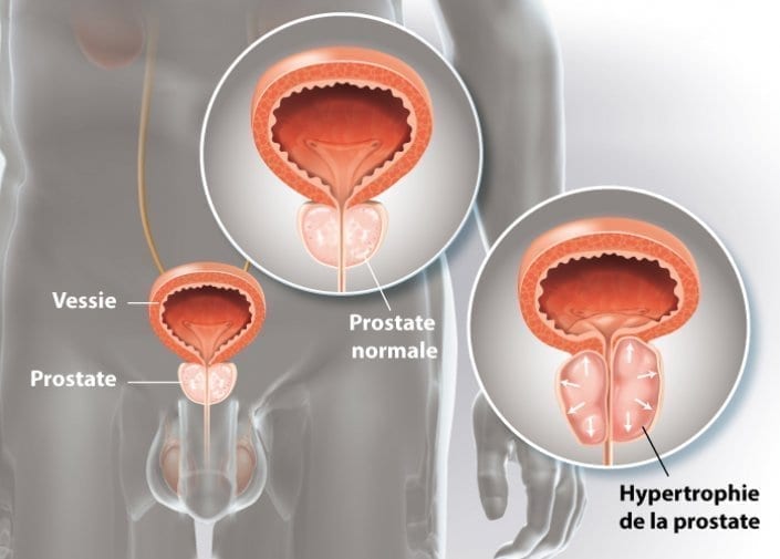 URO-adenome-prostate