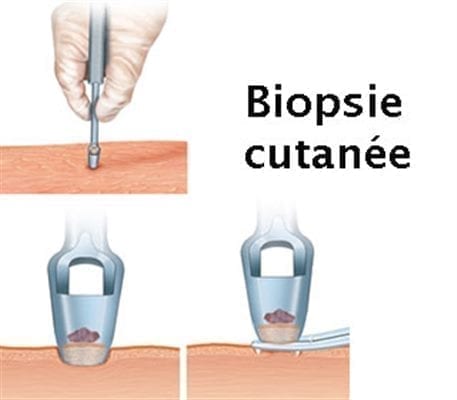 biopsie cutanee