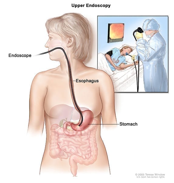 biopsie endoscopique