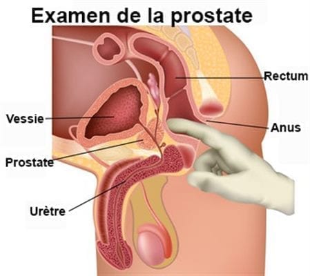 examen de la prostate