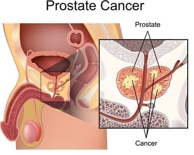 dessin cancer prostate