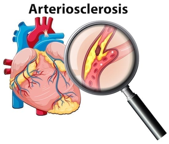 asthérosclérose