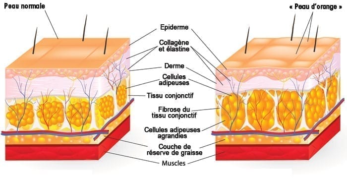 peau-avec-cellulite