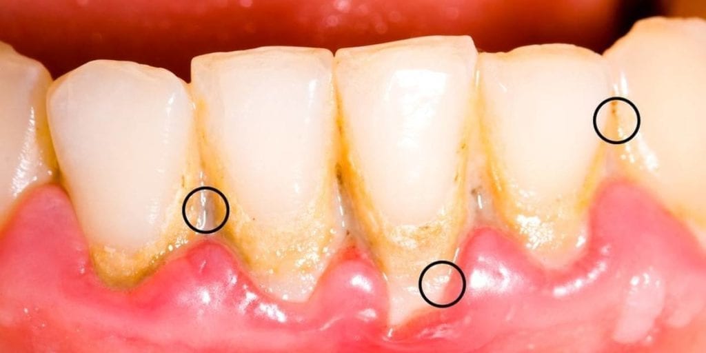 tartre dentaire